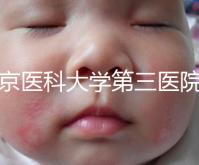 北京醫(yī)科大學(xué)第三醫(yī)院nt檢查費(fèi)用盤點需要多長時間,是否預(yù)約