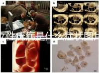 女性疣病是什么癥狀圖片(女生下面長了疙瘩圖片)