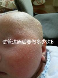 試管進周后要做多少次B超？需要檢查什么？進來看看
